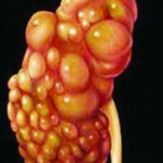 ADPKD sturcture