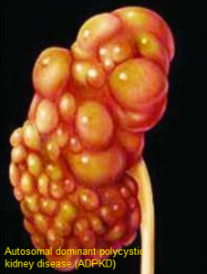 ADPKD sturcture