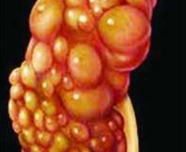 ADPKD sturcture