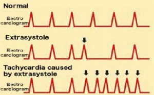 Atrial Extrasystole 