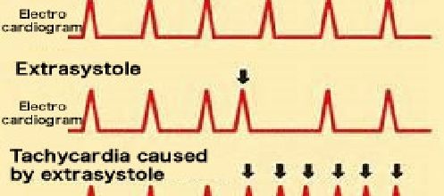 Atrial Extrasystole