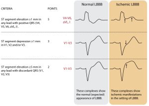 LBBB in ECG