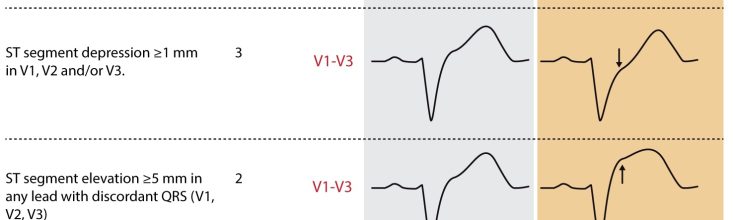 LBBB in ECG