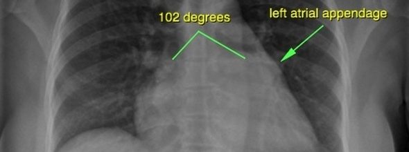 Left Atrial Enlargement CXR