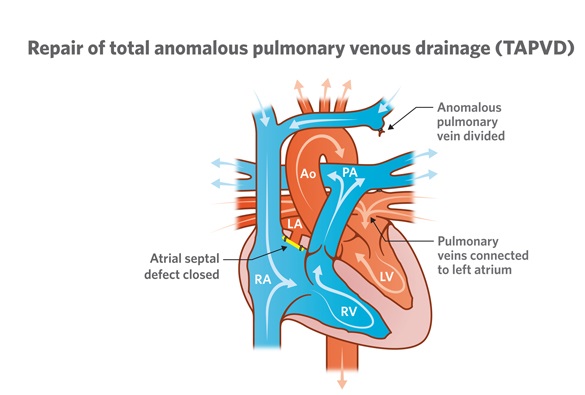 TAPVD Total Anomalous Pulmonary Venous Drainage | medlight2u.com