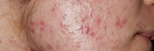 Acne Vulgaris Image