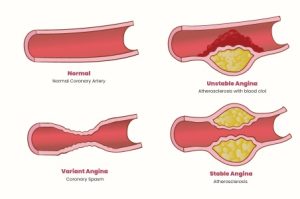 Angina