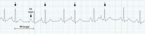 Atrial Extrasystole Image 2