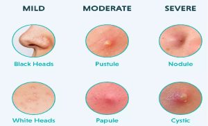 Black heads, Pustule, Nodule, White heads, Papule and Cystic Acne