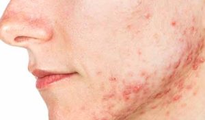 Cystic acne