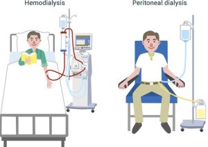 Hemodialysis and Peritoneal dialysis