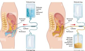 Peritoneal Dialysis