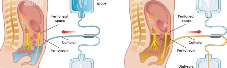 Peritoneal Dialysis