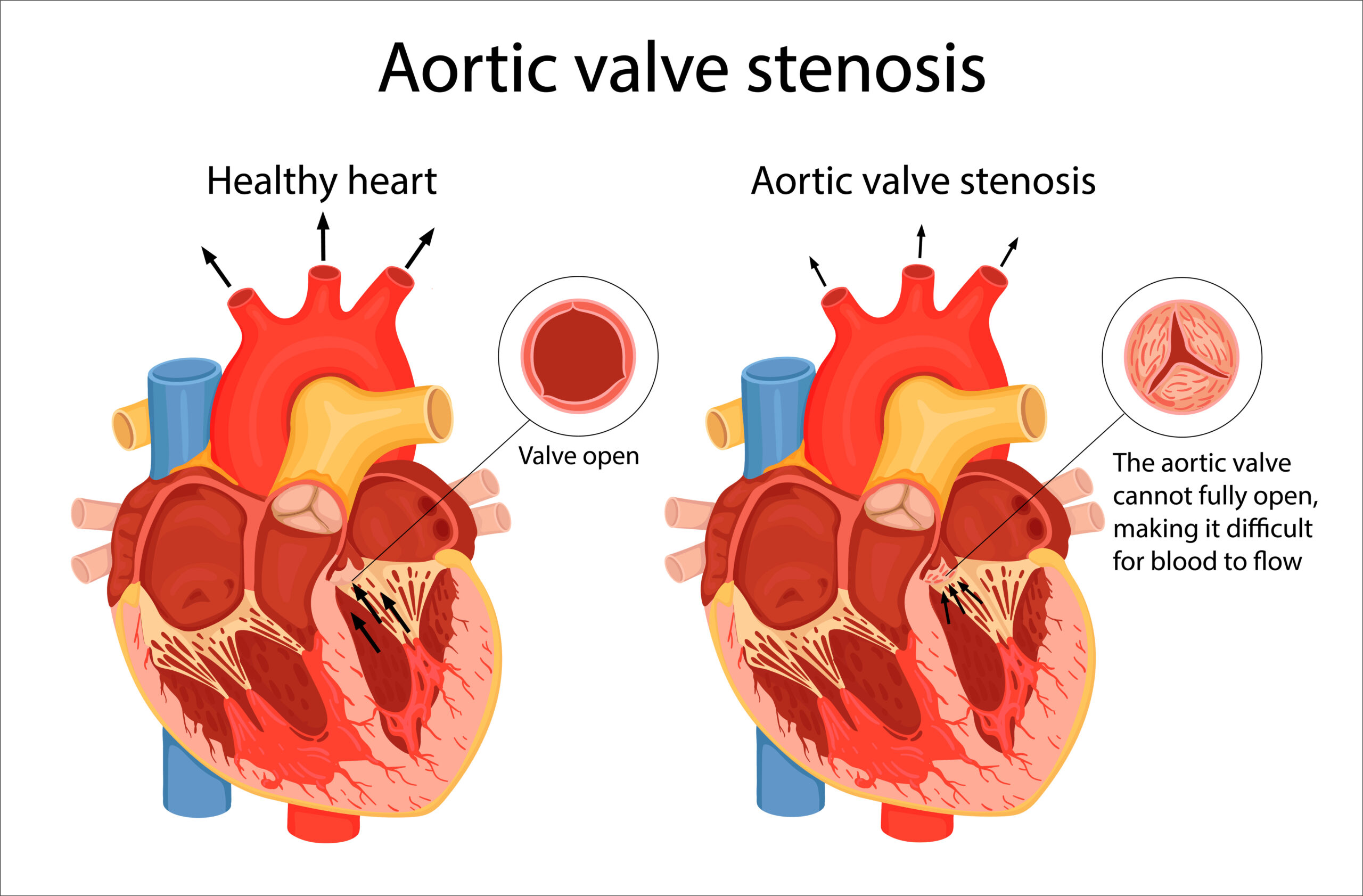 Aortic stenosis valve