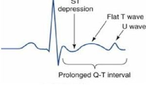 Hypokalemia in ECG