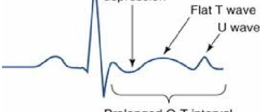 Hypokalemia in ECG