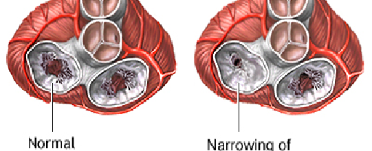 Mitral Stenosis Valve