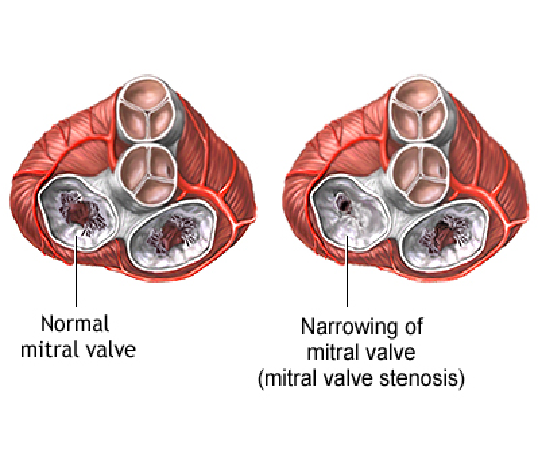 Mitral Stenosis Valve