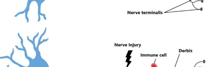 Myelin degeneration