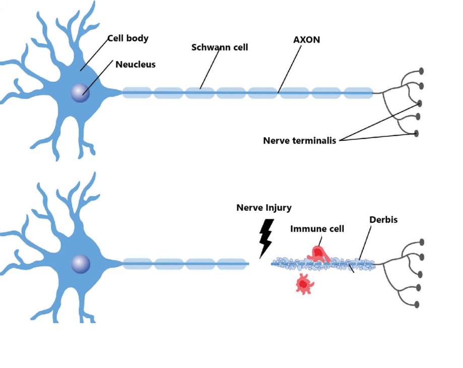 Myelin degeneration