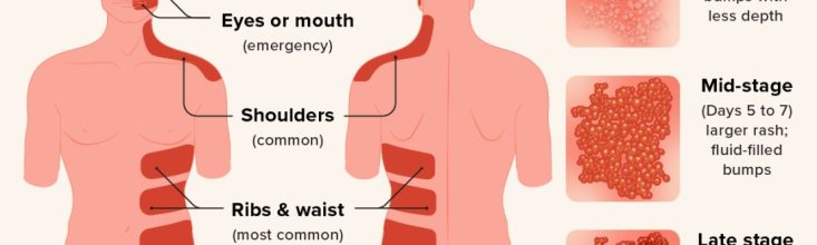 Shingles Lesion Common locations