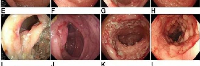 INTESTINAL TB