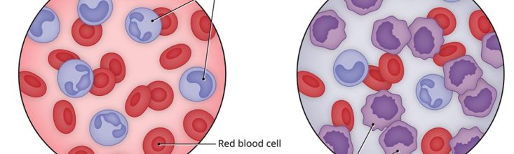 Leukemia Blood Cancer