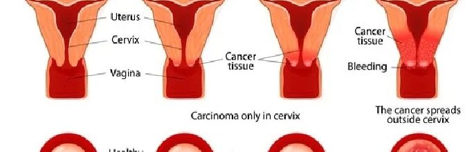 Stages of Cervical Carcinoma