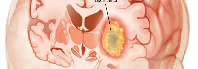 Brain tumors