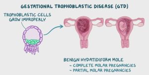 Gestational Trophoblastic Neoplasia (GTN)