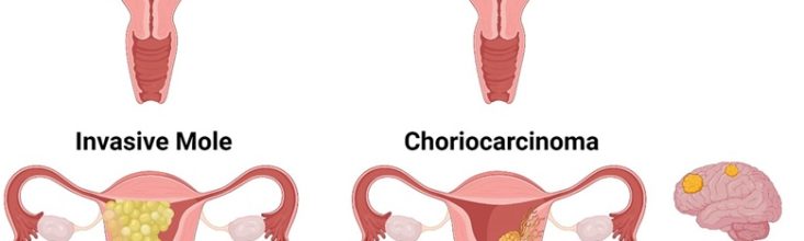 Gestational Trophoblastic Neoplasia (GTN) Moles
