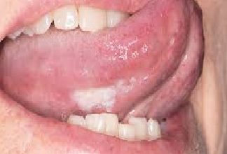 Oral cancer