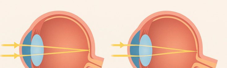 Normal and Presbyopic vision
