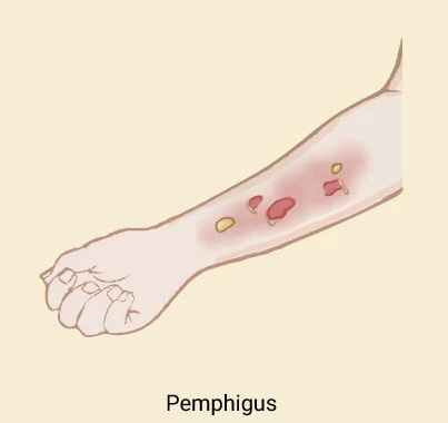 Pemphigus