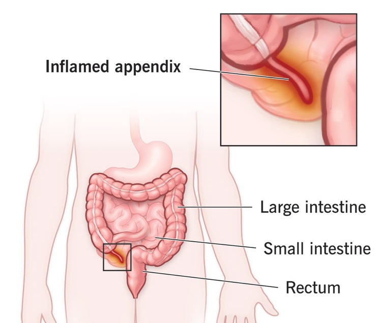Acute appendicitis